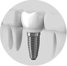 Dental Implants